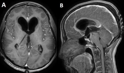 A postoperative day 1 T1 enhanced axial (A) and sagittal (B) MRI confirming complete surgical resection of the pineal tumor.