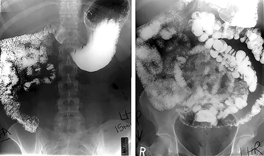 Preoperative upper gastrointestinal series.