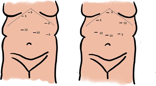 Port placement during laparoscopic Roux-en Y gastric bypass in setting of malrotation anatomical variant, standard port sites (a) and modified port sites (b).
