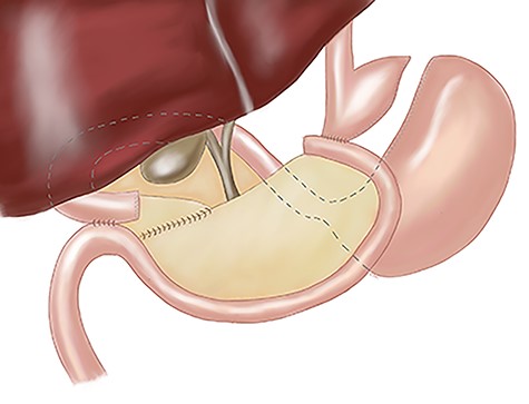 Anatomy postcompletion of Roux-en Y gastric bypass.