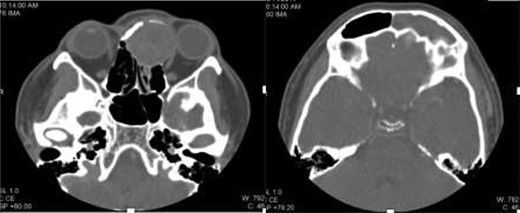 Axial contrast-enhanced CT image shows an expansile mildly enhancing soft-tissue mass in the anterosuperior nasal cavity and encroaching upon left orbital cavity. The mass causing remodeling of the left medial orbital wall and extension up to the level of the cribriform plate. The mass also obstructs the drainage of left frontal sinus with consequent left frontal retained secretion and sinusitis.