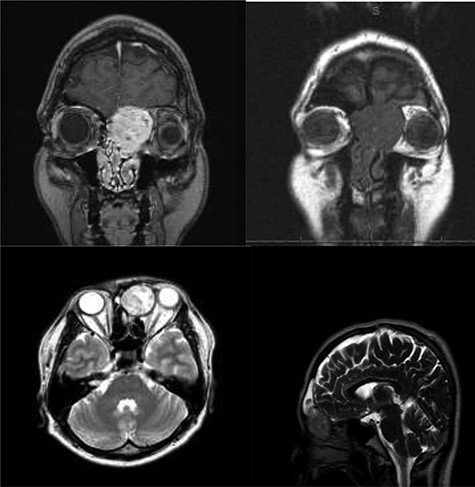 MR imaging: T1-weighted postcontrast image shows an enhancing mass that extends up to the nasal vault. No definite dural enhancement is identified. sagittal and parasagittal T1-weighted postcontrast images help to further confirm the presence of cribriform plate dehiscence but a lack of gross dural disease. No intracranial extension.T2 and non contrast T1 images show absence of intratumoral hemorrhage or Cystic components.
