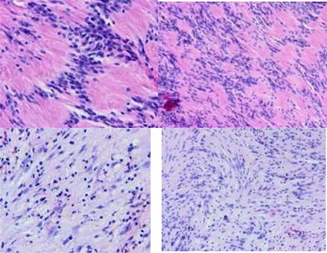 A biphasic histological pattern: Antoni A and Antoni B areas. Neoplastic palissading spindle-shaped Schwann cells proliferation that is arranged both compactly (Antoni A tissue) and loosely (Antoni B tissue). The Antoni A tissue contains frequent Verocay bodies. The neoplastic cells exhibit mild degree of nuclear pleomorphism with no detected mitosis or tumor necrosis. (Hematoxylin and eosin H%E, x10 and X40).