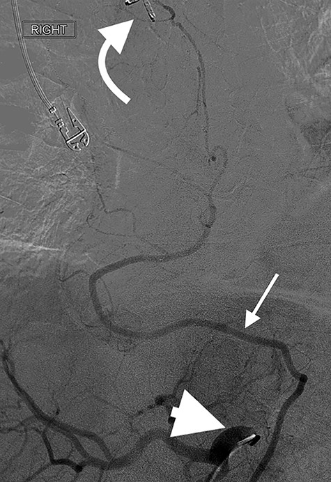 Angiography of the right gastro-epiploic artery. Arrowhead = celiac trunk; Arrow = right gastro-epiploic; Curved arrow = OG anastomosis.