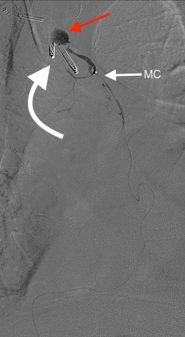 Angiography showing extravasation at the anastomosis. Curved arrow = OG anastomosis; Red arrow = contrast extravasation; Arrow MC = microcatheter.