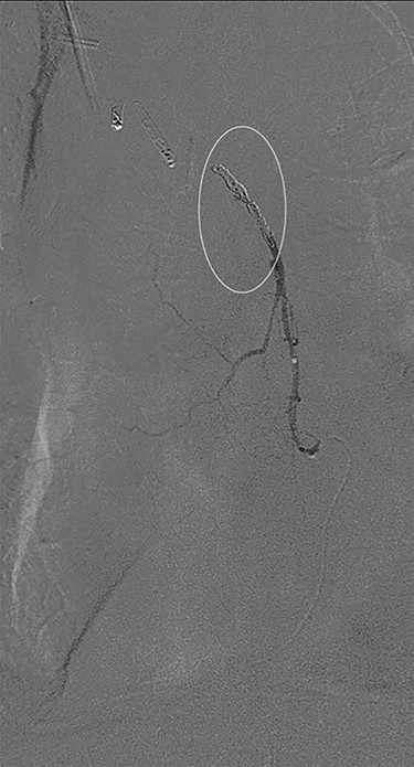 Successful coil embolization of the terminal portion of the gastro-epiploic arcade. Ellipse = coil.