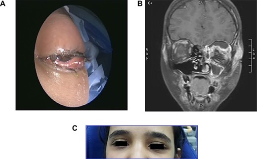 (A) Severly infected left eye with restricted movement, (B) CT sinuses and orbit with inflamed frontoethmoid sinuses and orbital abscess and (C) 6 weeks post-treatment.