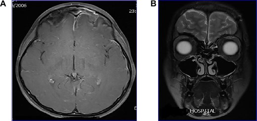 (A) MRI showing frontal sinusitis with meningitis and sagittal sinus thrombosis, (B) post-treatment MRI with clean sinuses and brain.