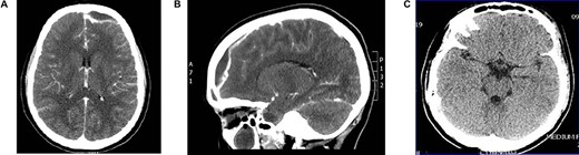(A) axial CT brain with subdural empyema, (B) sagittal CT scan with subdural empyema and (C) post drainage CT brain with complete resolution of subdural empyema.