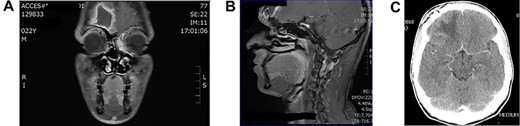 (A) Preoperation coronal MRI brain with large frontal lobe abscess, (B) preoperation sagittal MRI of frontal lobe abscess extending from inflamed frontal sinus and (C) post drainage CT brain showing complete resolution of the frontal abscess.