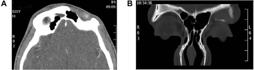 (A) Axial CT scan showing left frontal bone osteomyelitis and (B) CT sinuses showing left frontal bone osteomyelitis with discharging fistula.