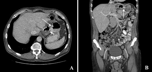 Computed tomography with intravenous contrast images demonstrating a gastro-gastric fistula (arrows). A: axial reconstruction; B: sagittal reconstruction.