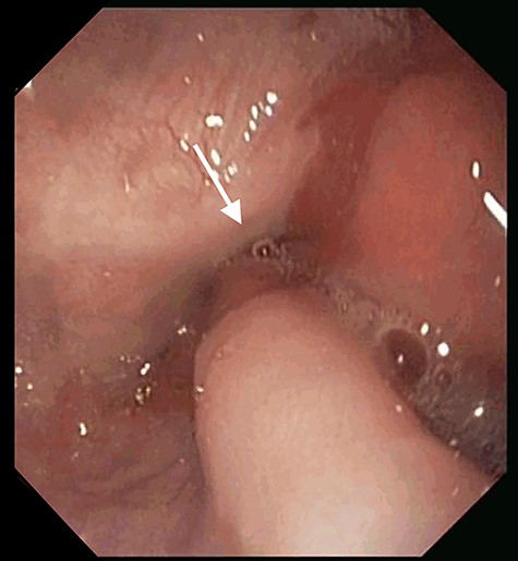 Esophagogastroduodenoscopy image showing a normal gastric pouch with only one orifice corresponding to the gastro-jejunal anastomosis (arrow).