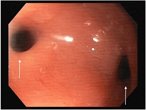 Esophagogastroduodenoscopy image showing a gastro-gastric fistula (on the right) and stenosis of the gastro-jejunal anastomosis (on the left), marked with arrows.