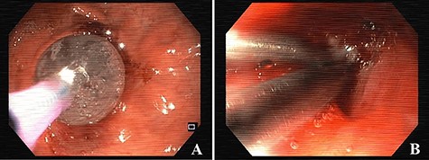 Esophagogastroduodenoscopy images showing dilation of the gastro-jejunal anastomosis (A) and closure of gastro-gastric fistula with clips (B).