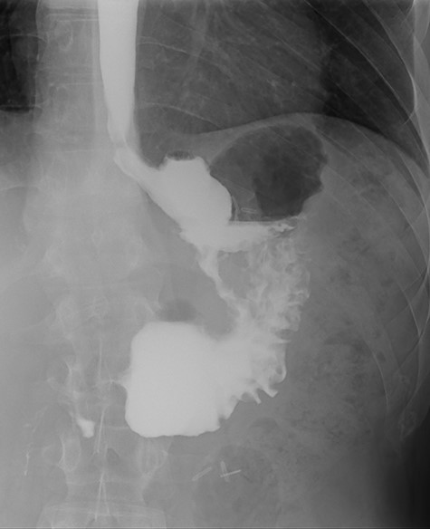 Upper gastrointestinal contrast swallow study image where it is possible to see a gastro-gastric fistula with opacification of the excluded stomach.