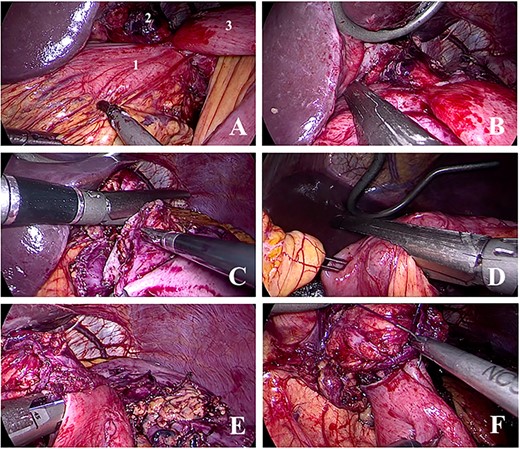 Images from the surgical procedure. A: Identification of the excluded stomach (1), gastric pouch (2) and jejunum (3). B: Section of the gastric remnant distal to the fistula. C: Section of gastric pouch proximal to the gastro-jejunal anastomosis and the gastro-gastric fistula. D: Section of the jejunum distal to the gastro-jejunal anastomosis. E: Reconstruction of the gastro-jejunal anastomosis—mechanical part. F: Reconstruction of the gastro-jejunal anastomosis—manual part (closure of the orifice from the stapler).