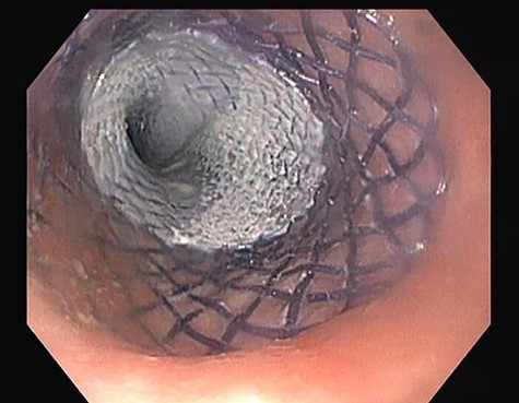 Esophagogastroduodenoscopy image showing a covered biodegradable stent occluding the proximal orifice of the oesophageal fistula.