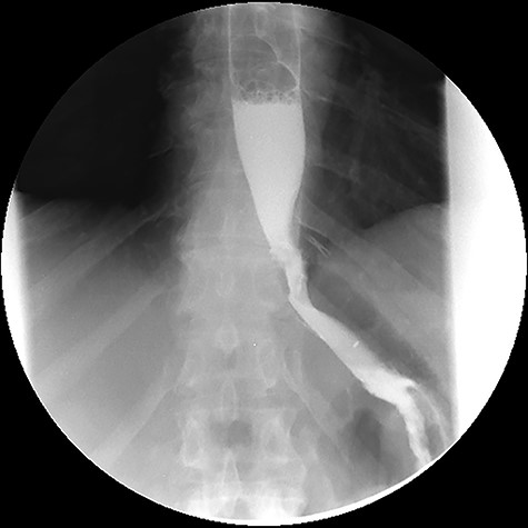 Upper gastrointestinal contrast swallow study image where is possible to see normal progression of contrast from the oesophagus to the stomach without leaks.