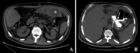 Computed tomography images. A: Image obtained prior to administration of contrast showing an abscess on the left upper quadrant of the abdomen (asterisk). B: Image obtained after administration of oral contrast showing progression of contrast through the gastro-jejunal anastomosis and through the gastro-gastric fistula (arrows).