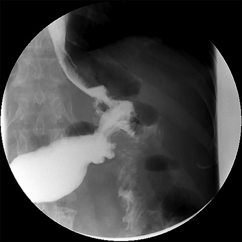 Upper gastrointestinal contrast swallow study image showing progression of contrast from the oesophagus to the gastric pouch and from the gastric pouch to the excluded stomach, confirming a gastro-gastric fistula.