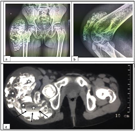 X-ray of the pelvis in frontal view (a) and of the right elbow in profile (b); and CT-scan without contrast media of the pelvis in soft tissue window (c), showing a calcified, multi-lobed mass containing fluid components (asterisk) with liquid–liquid level (arrows) in the extra-articular soft tissues. Note: the absence of joint or bone lesion detected.
