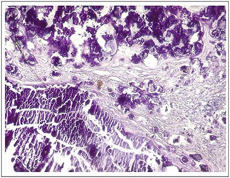 Microphotograph of the specimen hematoxylin and eosin (H–E stain, ×10) showing cystic lesion consisting of central granular or amorphous material, calcified, surrounded by a macrophage reaction with multinucleated giant cells and mononuclear inflammatory elements; associated with numerous osteoid deposits scattered in amorphous layers with surrounding non-inflammatory fibrous tissue.