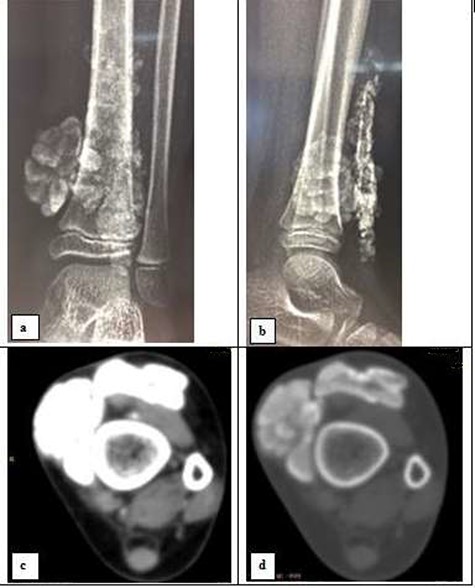 Radiography in frontal view (a) and profile (b); and CT-scan in soft tissue window (c) and bone window (d) of the left ankle showing a calcified polylobed mass in the extra-articular soft tissues and the lower third of the leg.