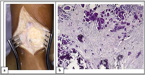 Intraoperative photograph of the mass showing a whitish appearance (a) and microphotograph revealing calcified amorphous material, surrounded by a macrophage reaction with multinucleated giant cells and mononuclear inflammatory elements; associated with numerous osteoid deposits scattered in amorphous layers with surrounding non-inflammatory fibrous tissue (H–E stain, ~10).