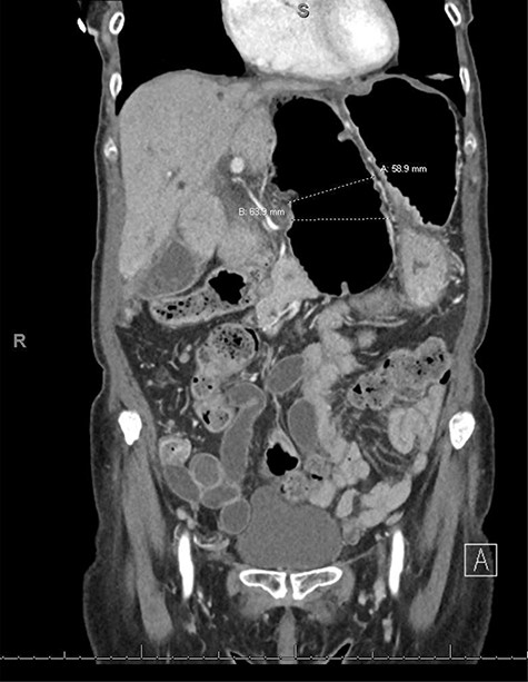 CT coronal view showing dilated loop of transverse colon medial to the lesser curvature of the stomach dilated to ~6 cm, which is involved in an internal hernia.