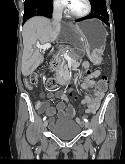 CT coronal view showing proximal and distal loops of transverse colon are seen in the region of the foramen of Winslow.