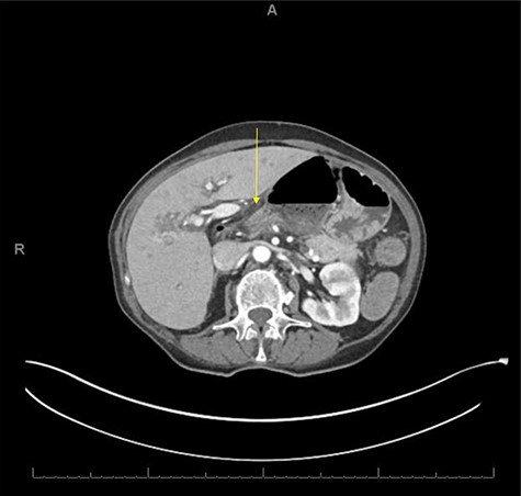 CT axial view showing proximal and distal loops of transverse colon are seen traversing through the foramen of Winslow.