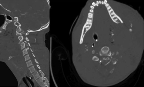 CT angiogram of the neck demonstrates a bullet trajectory through the left C2–3 facet with fractured c3 posterior elements and bullet and bony fragments within the canal at the C3–4 level; left: sagittal view; right: axial view.