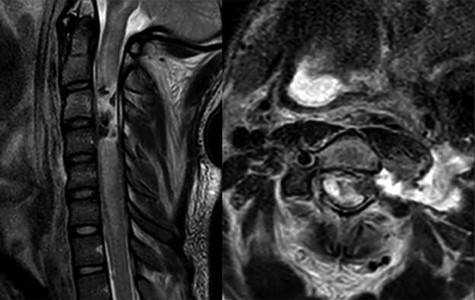 MRI T2 weighted sequence sagittal (left) and axial (right) at the c3 level demonstrates severe spinal cord damage, canal obliteration from c3 to c6 and a large left sided csf fistula at the C3 level.