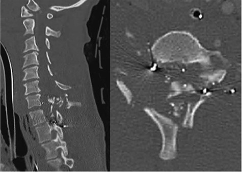 CT cervical spine; sagittal (left): demonstrates comminuted c6, c7 and T1 fractures, and the axial (right) demonstrated complete spinal obliteration with bullet and bone fragments at the C6/7 level.