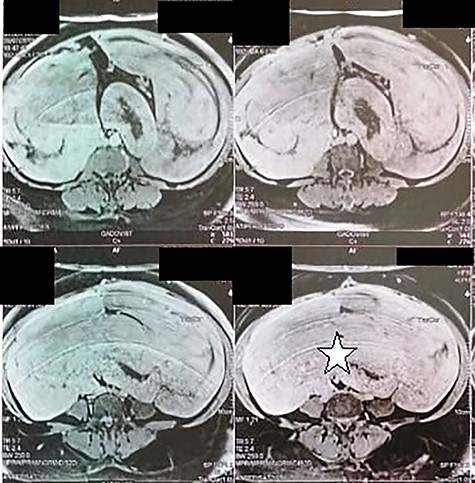 Abdominal magnetic resonance showing a 32 × 29 × 12 cm retroperitoneal tissular mass with a signal that is isointense to that in muscle on T1-weighted images (white star).