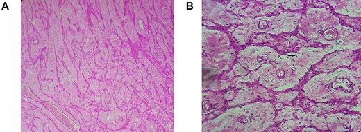 Retroperitoneal leiomyoma’ histology: mature smooth muscle cells with blunt-ended nuclei (black arrow), and abundant eosinophilic cytoplasm arranging in intersected fascicles. (A) Hematoxylin and eosin, ×100. (B) Hematoxylin and eosin, ×400.