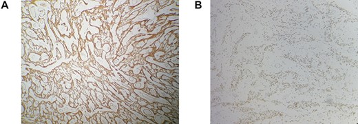 Immunohistochemistry findings: strong and diffuse positivity with desmin (A), estrogen receptors (B). Immunohistochemical stain, ×200.