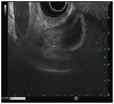 Endoscopic ultrasound shows an echogenic polyp in the infundibulum of the gallbladder.