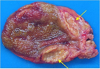 Polyp observed in macroscopic examination.