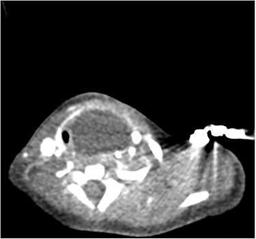 Axial CT illustrating left supraglottic cyst.