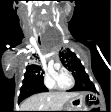 Coronal CT illustrating left supraglottic cyst.