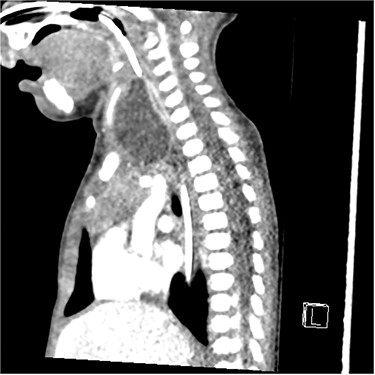Sagittal CT illustrating left supraglottic cyst.