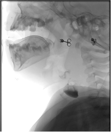 Sagittal barium sallow illustrating the presence of an oesophageal diverticulum, filled with contrast on swallowing.