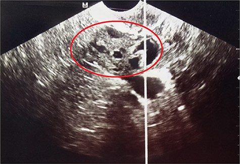 Pelvic ultrasound showing the right-solid cystic ovarian mass with intracystic vegetations (red circle).