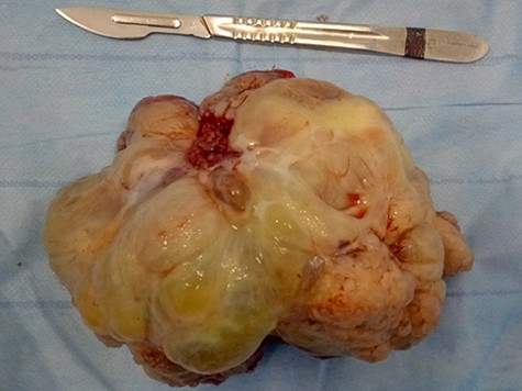 Surgical specimen of the resected right adnexa mass.