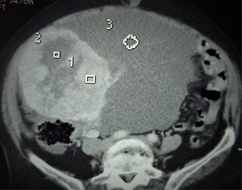 Axial CT scan showing the bulky abdominopelvic mass (3) with solid and cystic components (1 and 2, respectively).