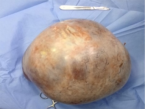 Surgical specimen of the resected bulky right adnexal mass with a thin-wall multilocular cyst.