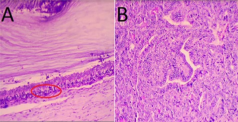 Microscopic findings. (A) Features of thyroid papillary carcinoma on ovarian teratoma with multilocular mucinous cystadenoma (red circle); (B) crowded overlapping nuclei with elongated powdery chromatin. Hematoxylin and eosin staining; magnification: A: ×40, B: ×400.