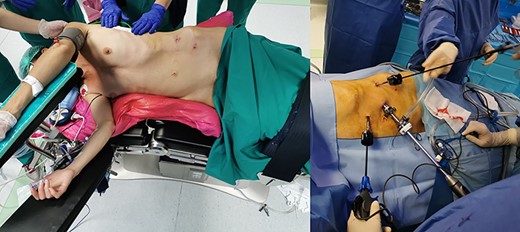 Patient placement on the operating table. Placed in lateral decubitus position with the affected side elevated around 60°. An optical 10–12 mm trocar is placed on the umbelical line on the left and two 5-mm trocars operating laterally in the left hypochondrion and on the left side on the mid-axillary line.
